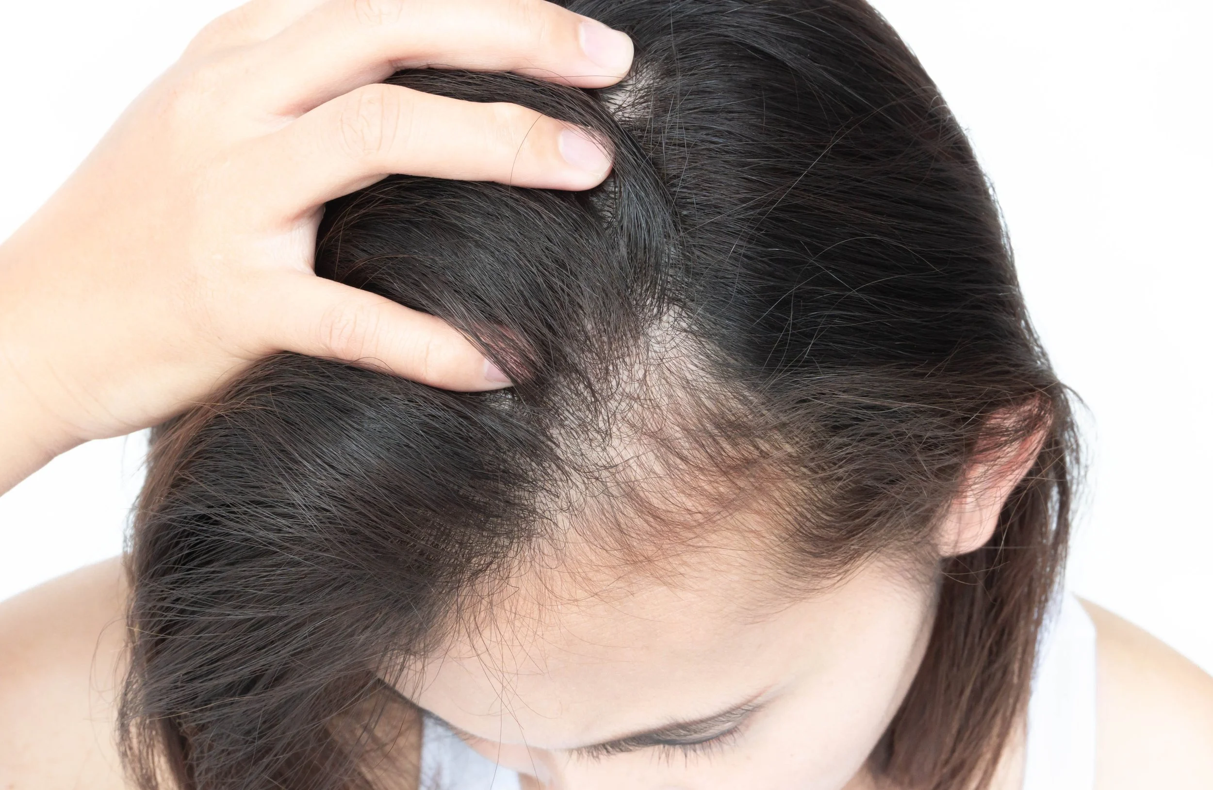 Homeopathic treatment for Telogen Effluvium (Stress-induced temporary hair shedding)